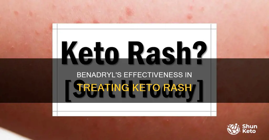 does benadryl help keto rash