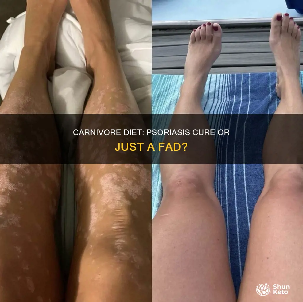 does carnivore diet cure psoriasis