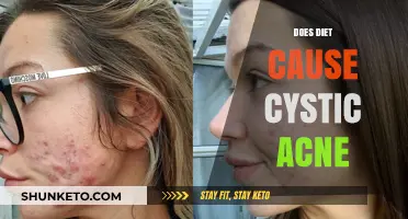 Diet's Role in Cystic Acne: What You Need to Know