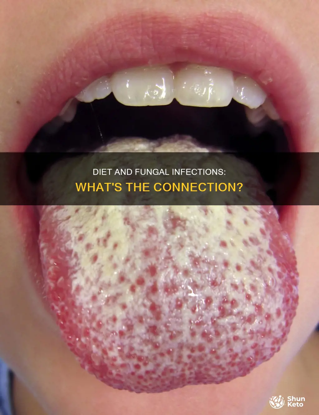does diet cause fungal infection