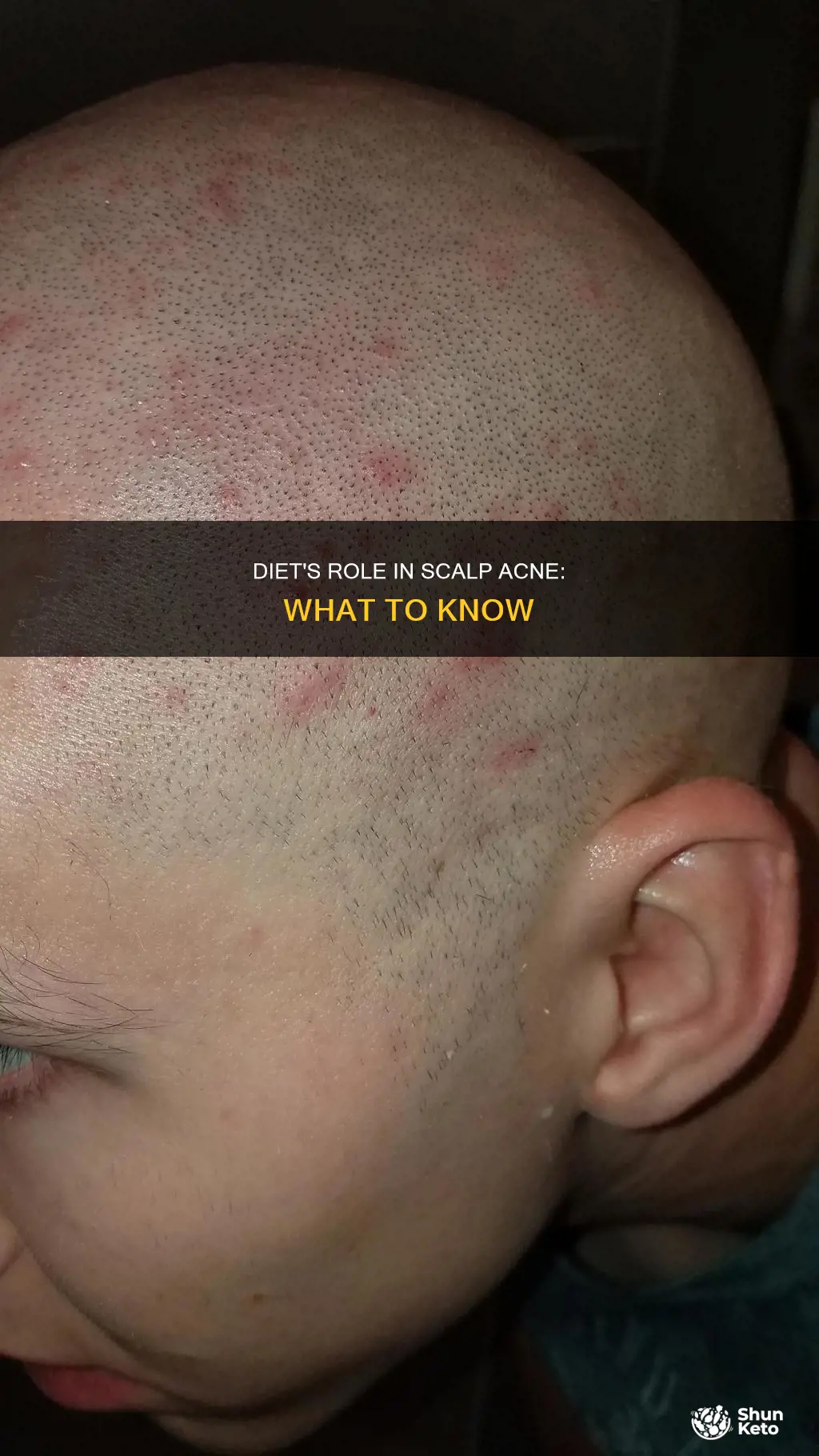 does diet cause scalp acne