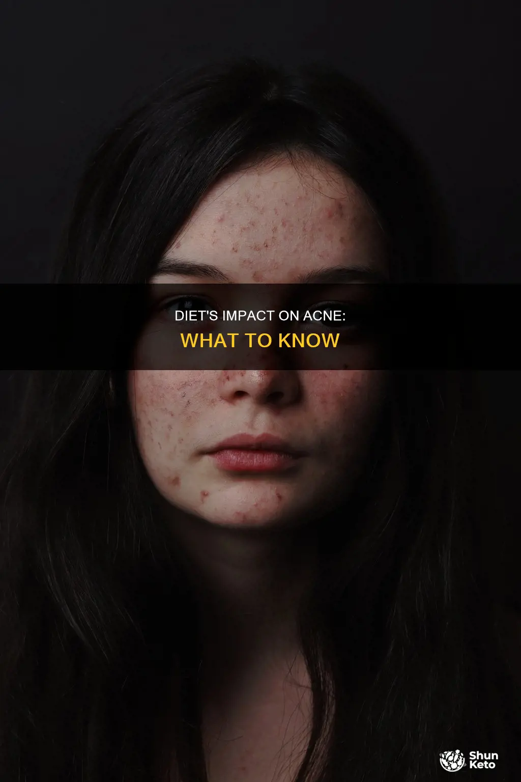 does diet effect acne