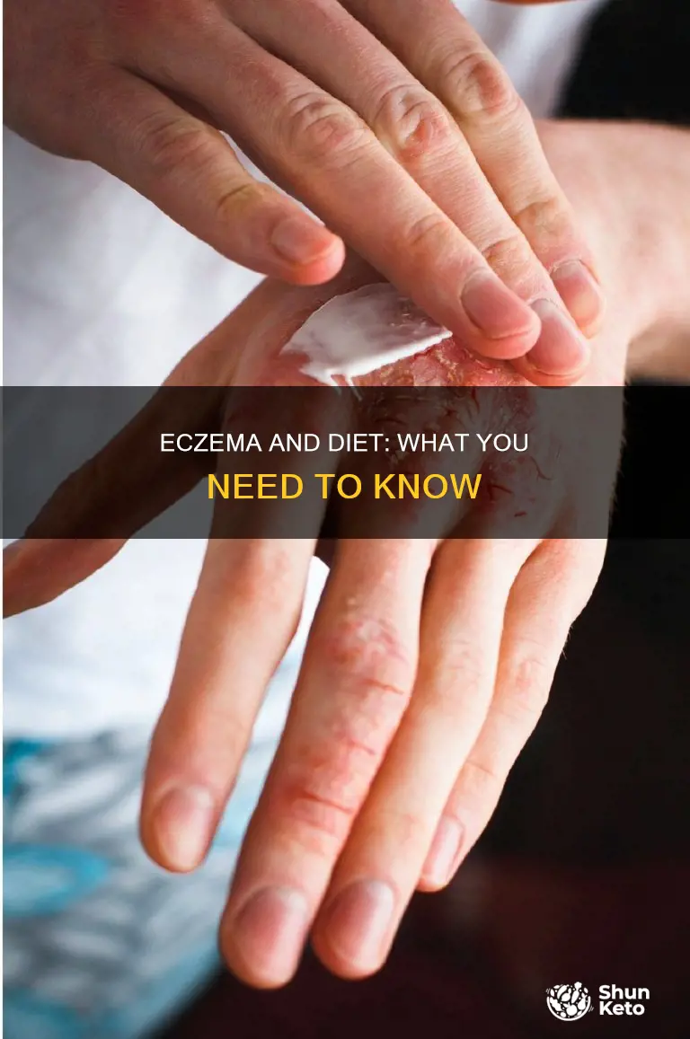 does diet help eczema