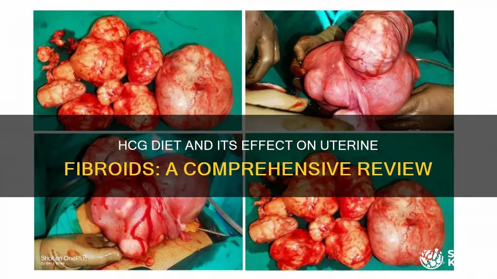 does hcg diet impact fibroids