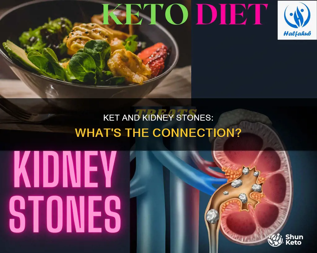 does ket cause kidney stones