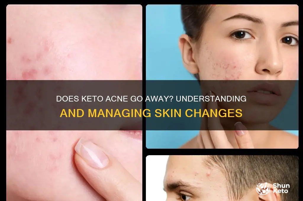 does keto acne go away