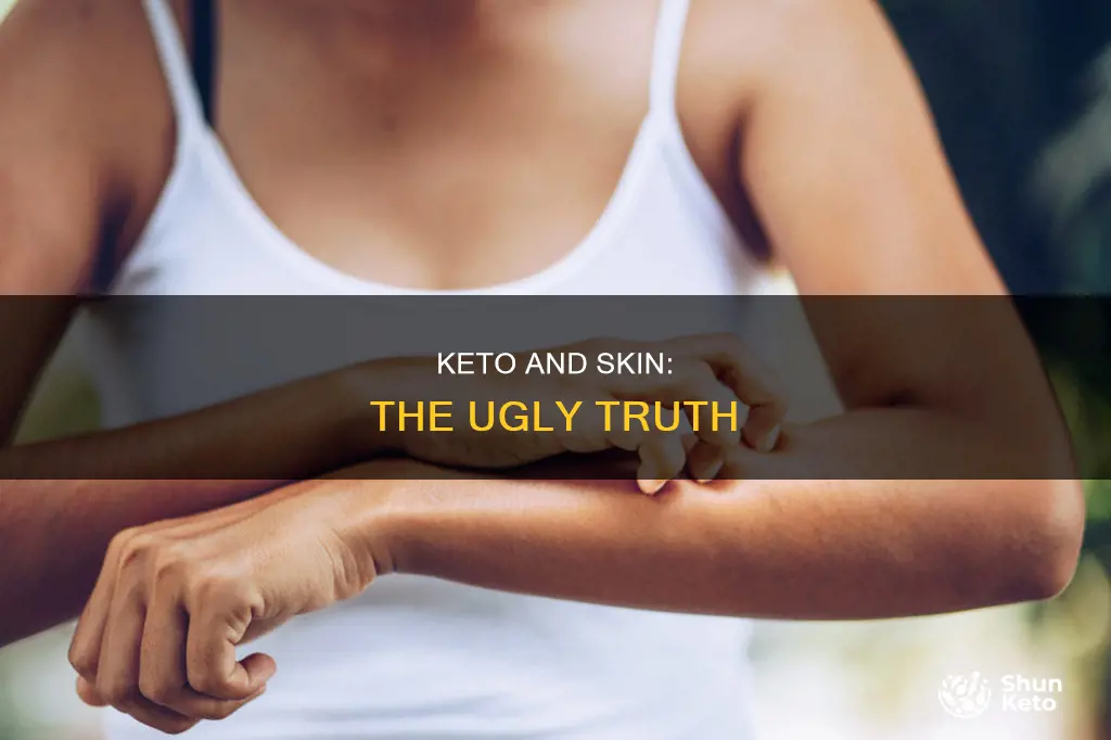 does keto cause bad skin