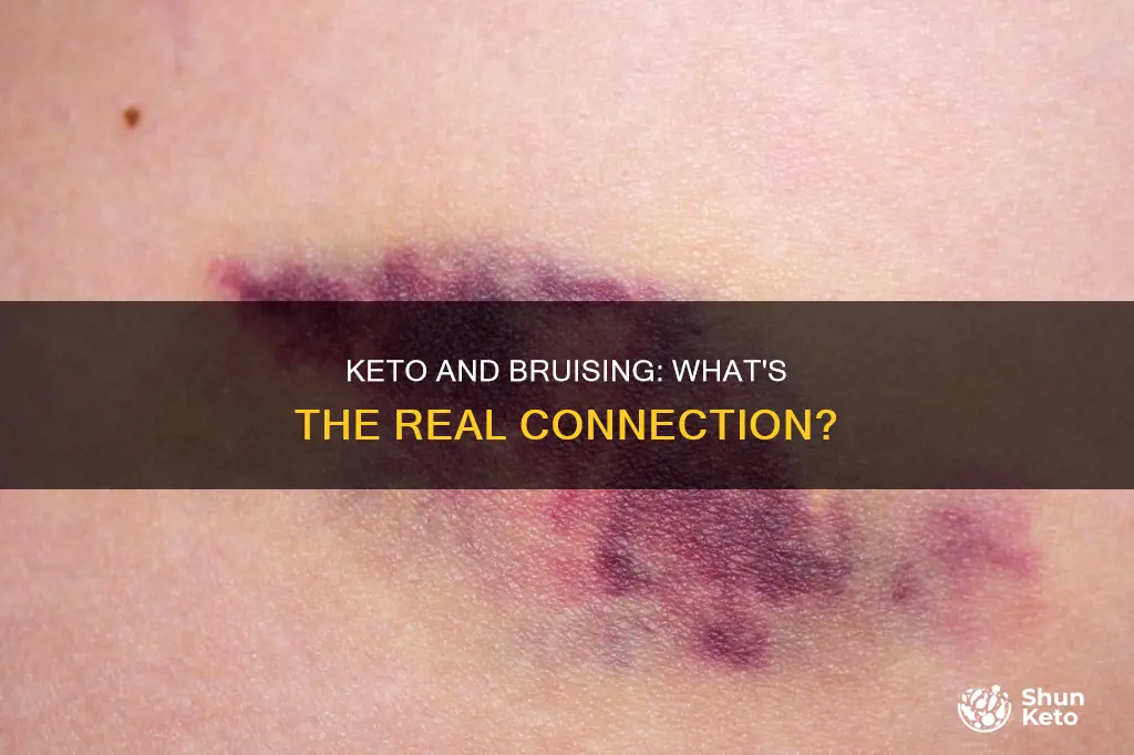 does keto cause bruising