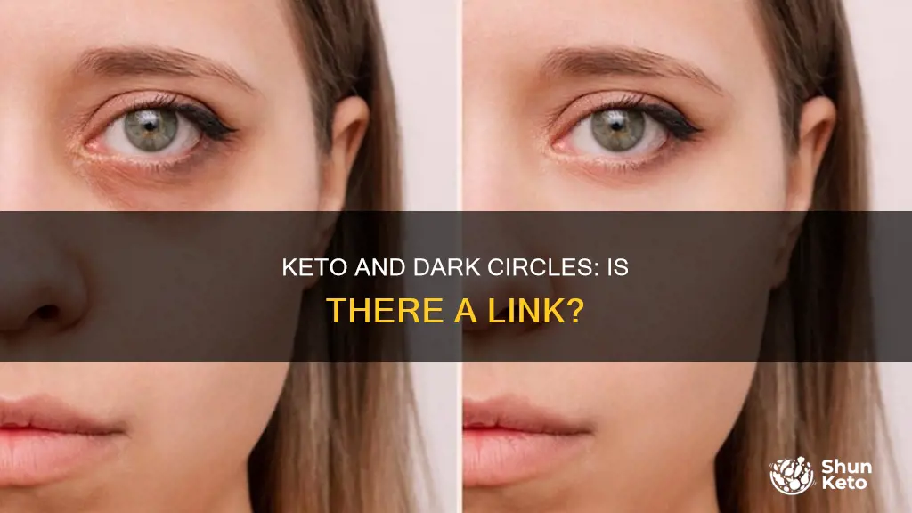 does keto cause dark circles