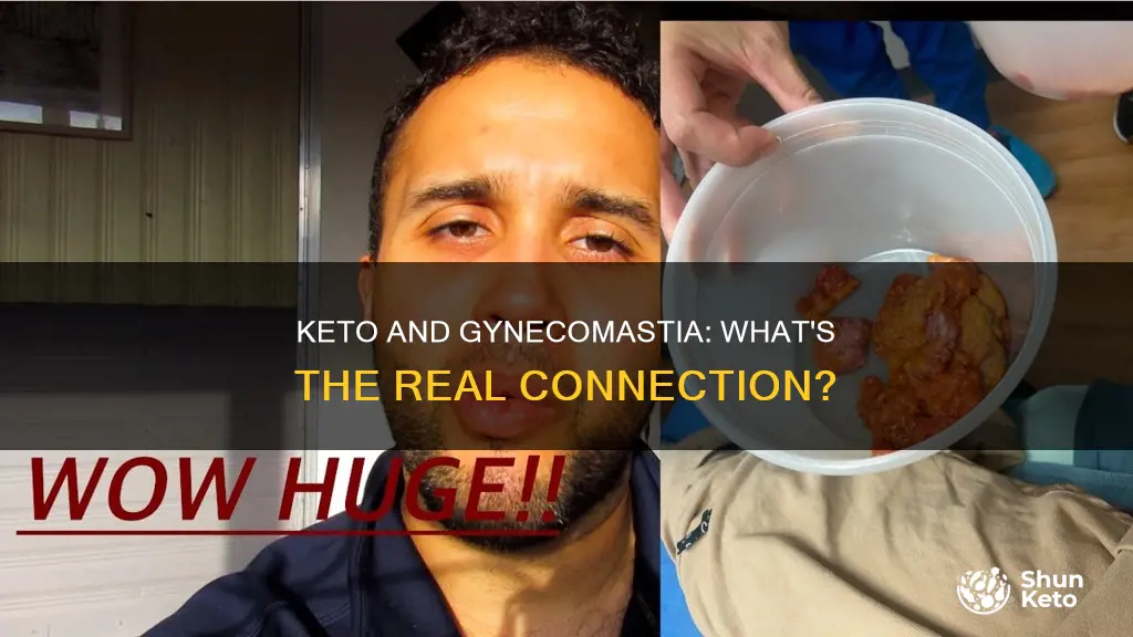 does keto cause gynecomastia