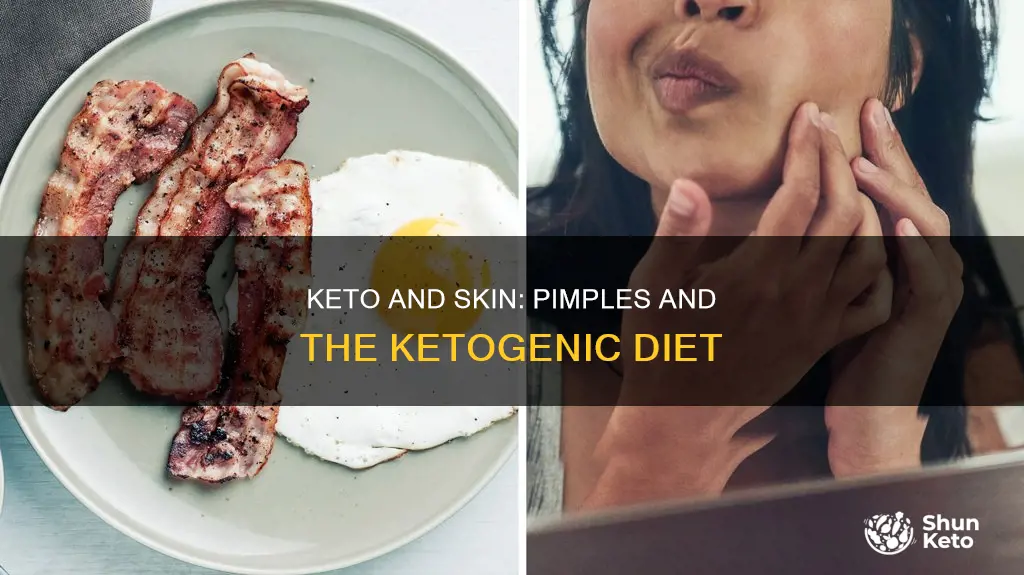 does keto cause pimples