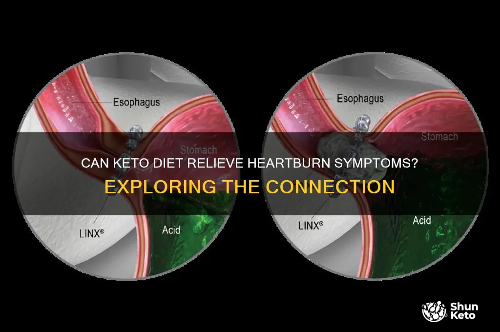 does keto cure heartburn