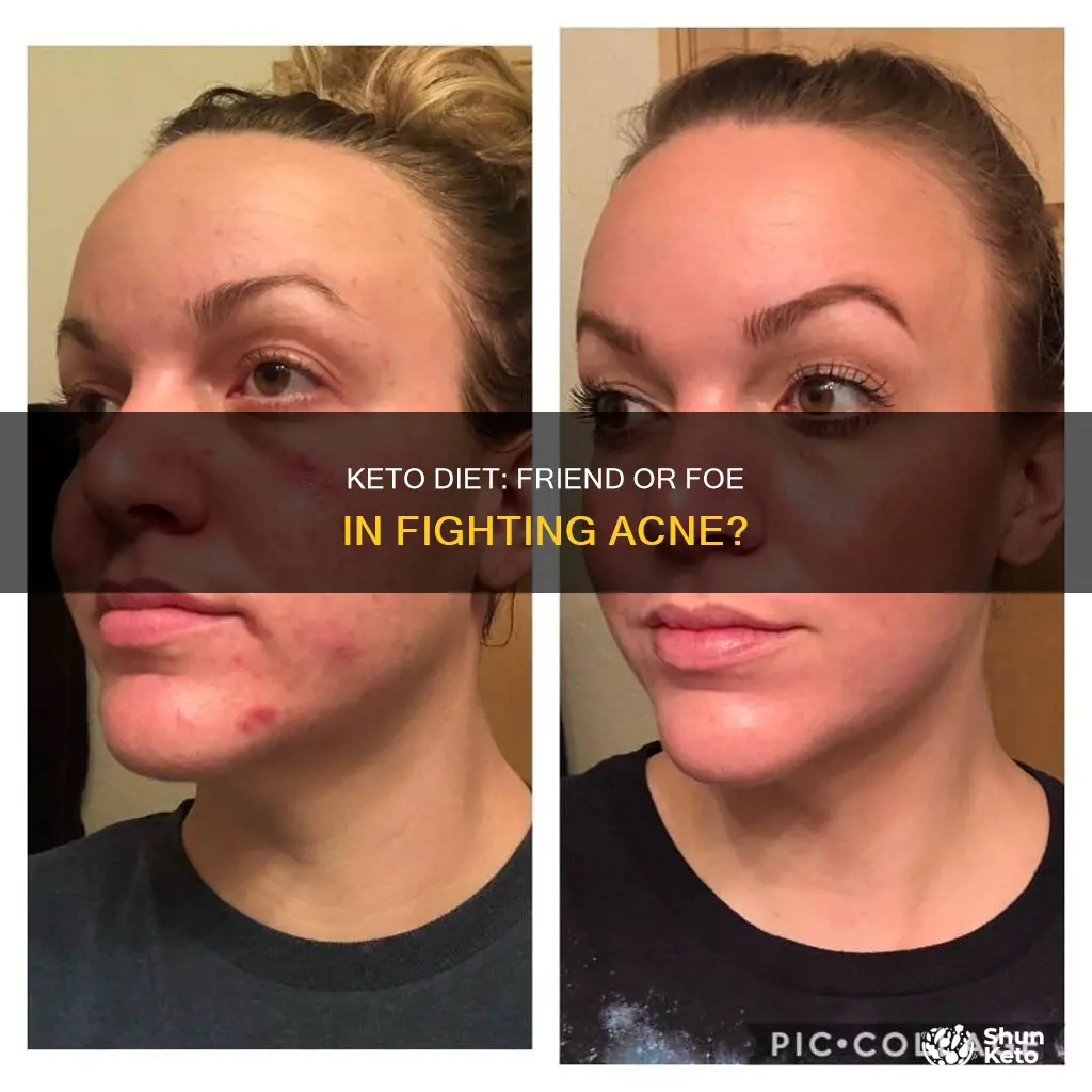 does keto help acne