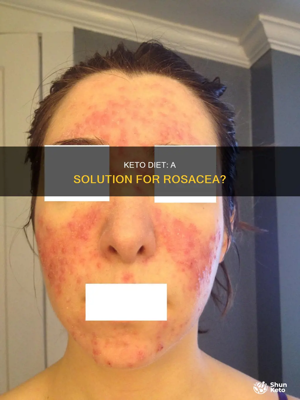 does keto help rosacea