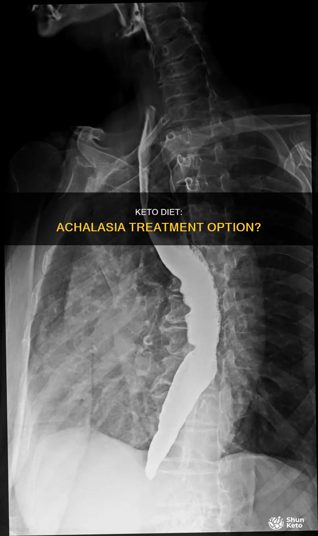 does keto help with achalasia