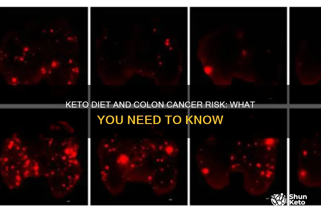 does keto put you at risk for colon cancer