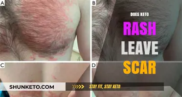 Keto Rash Scarring: What to Expect and How to Prevent Marks