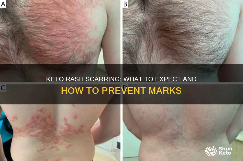 does keto rash leave scar