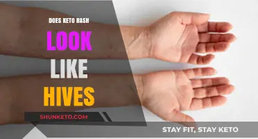 Keto Rash vs. Hives: Identifying Differences and Similar Skin Symptoms