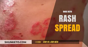 Does Keto Rash Spread? Understanding Symptoms, Causes, and Treatment Options
