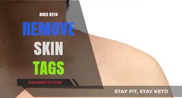 Can Keto Diet Help Remove Skin Tags? Exploring the Connection