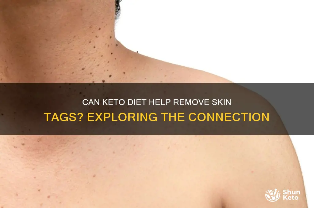 does keto remove skin tags