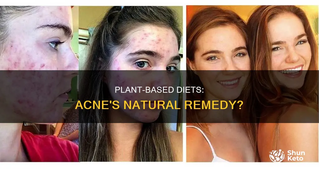 does plant based diet reduce acne