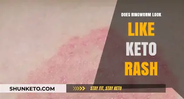 Ringworm vs. Keto Rash: Identifying Skin Differences and Similarities