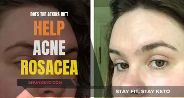 Atkins Diet: A Solution for Acne Rosacea?