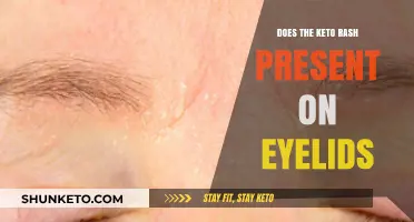 Keto Rash on Eyelids: Causes, Symptoms, and Effective Treatment Options