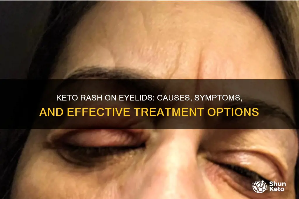 does the keto rash present on eyelids