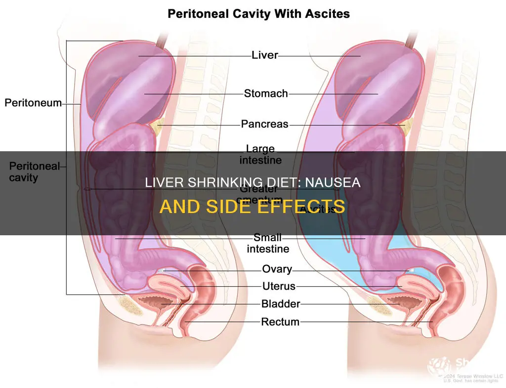 does the liver shrinking diet cause nausea