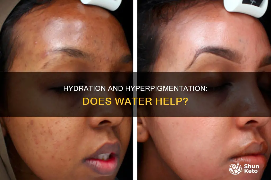 does water and diet help with hiperpigmentation