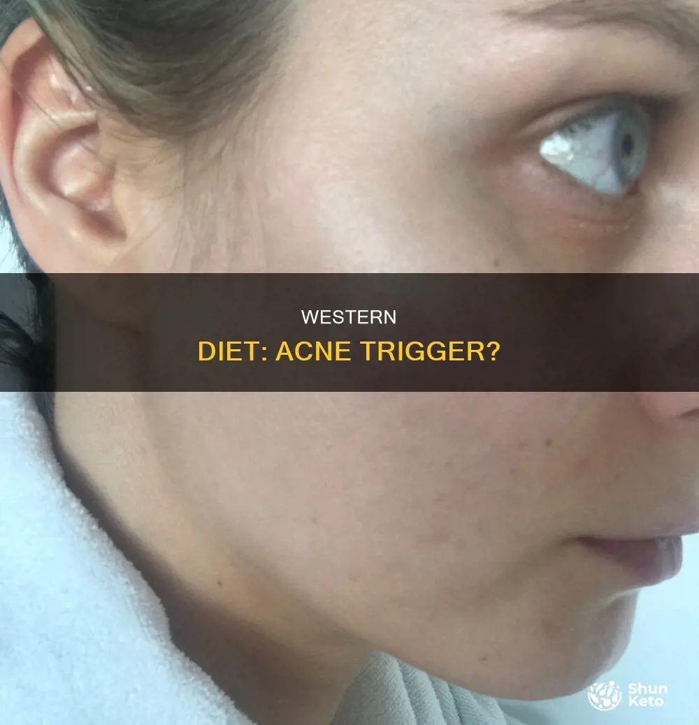 does western diet cause acne