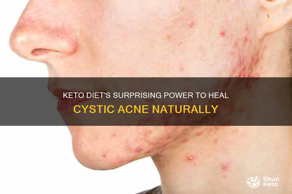 how can keto cure cystic acne