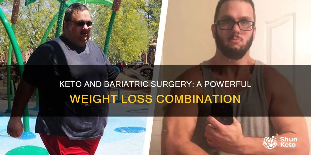 how does keto and bariatric sleeve surgery work