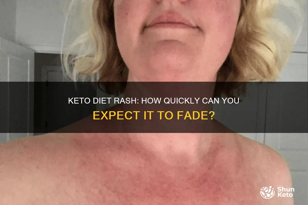 how fast will the keto diet rash disappear