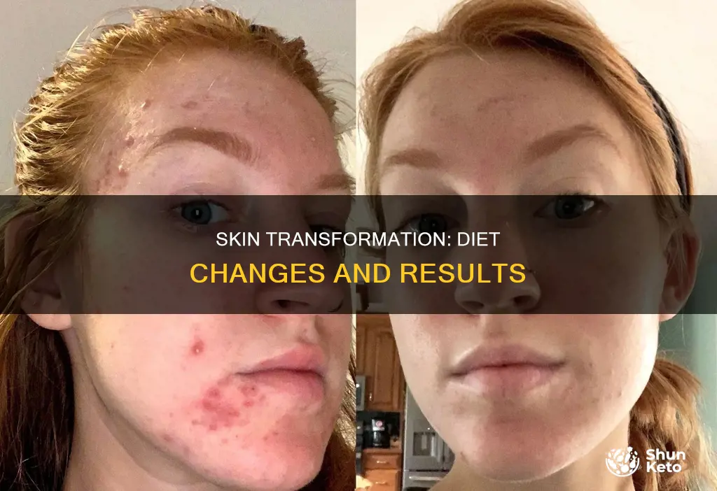 how long after diet change for skin to clear up