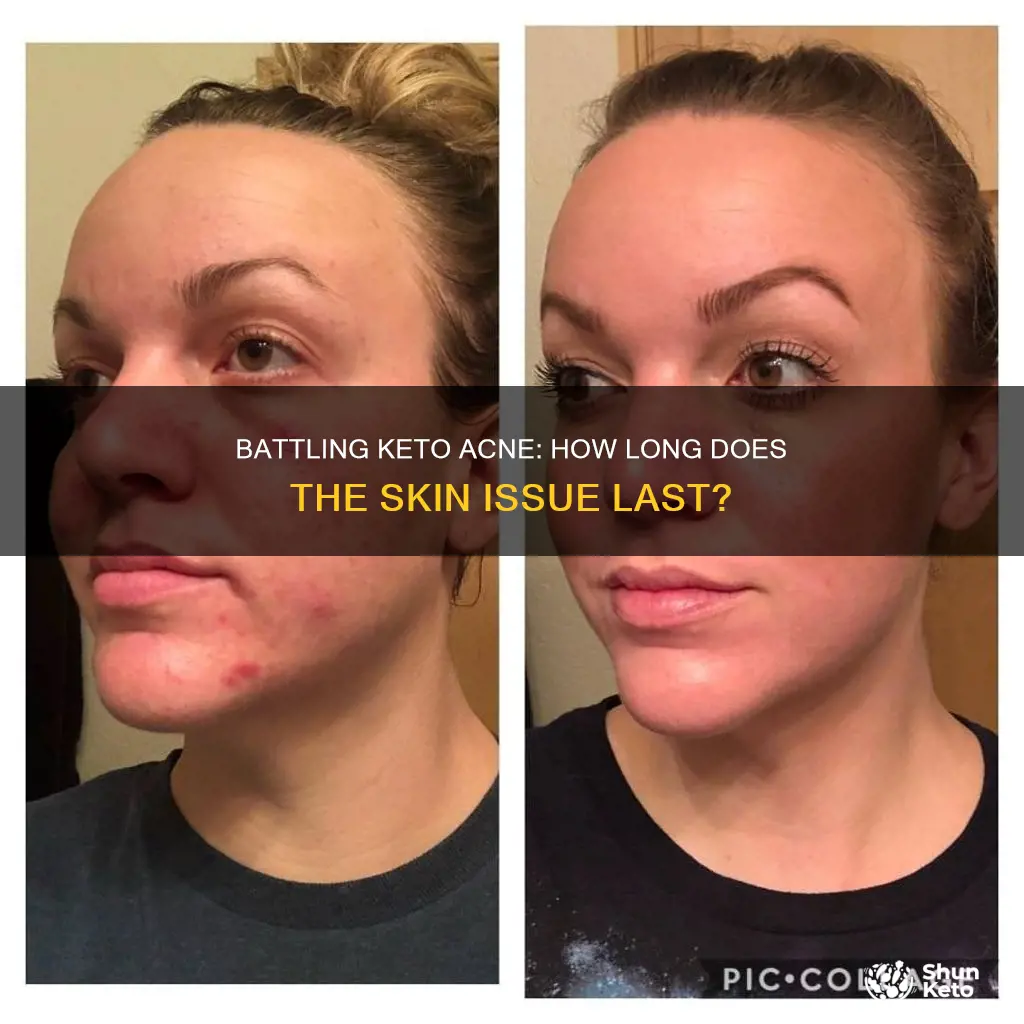 how long does keto acne last