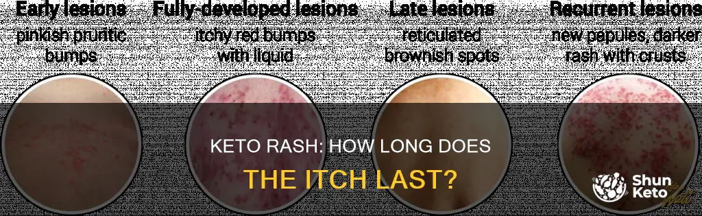 how long does keto rash last