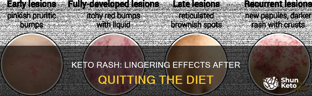 how long keto rash after quitting keto