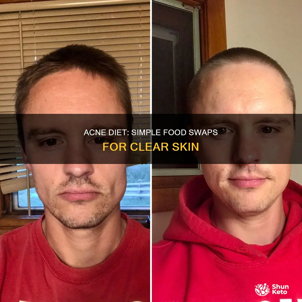 how to change diet for acne