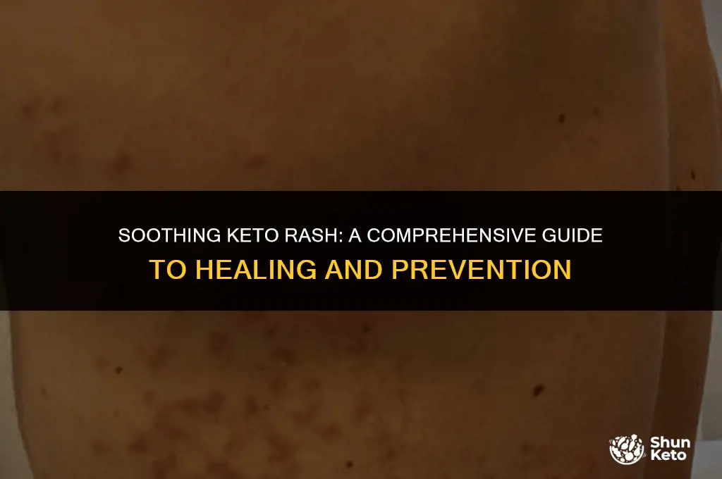 how to heal keto rash