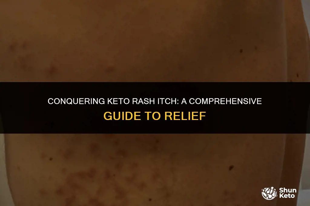 how to kill keto rash itch