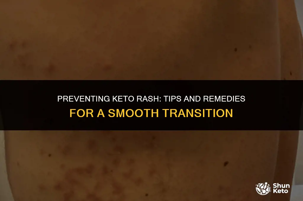 how to prevent keto rash