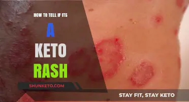 Identifying Keto Rash: Symptoms, Causes, and Effective Treatments