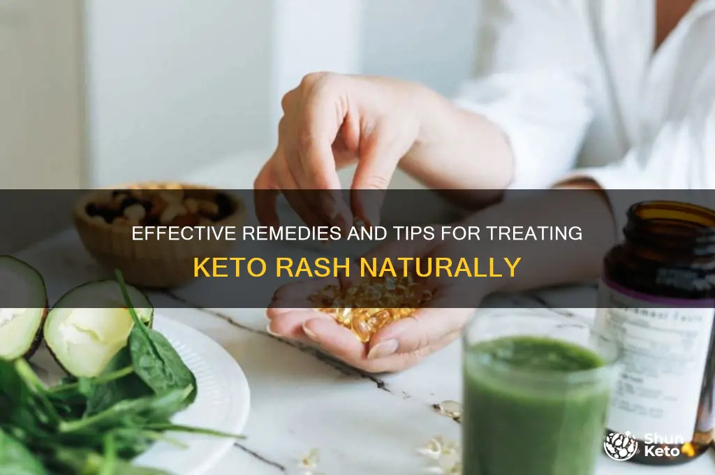 how to treat keto rash