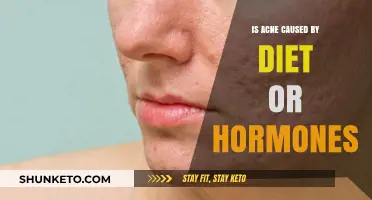 Acne: Diet or Hormones?
