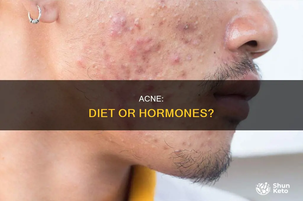 is acne caused by diet or hormones