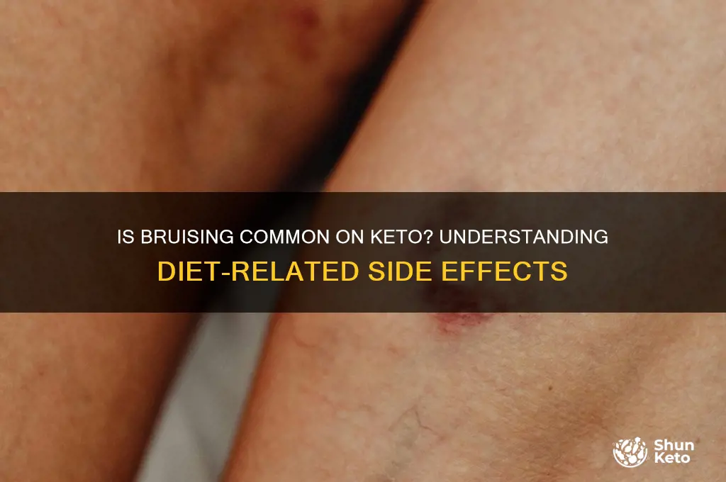 is bruising common on keto diet